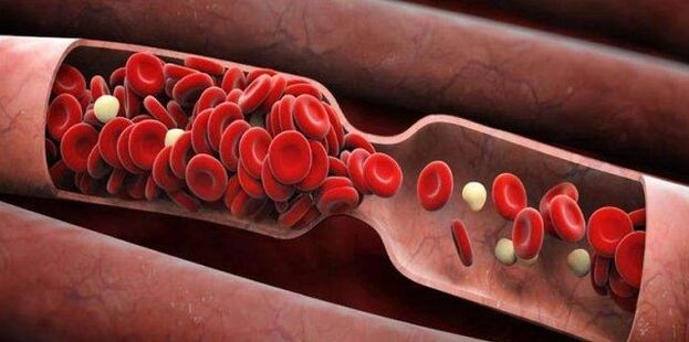 Prevención de coágulos de sangue