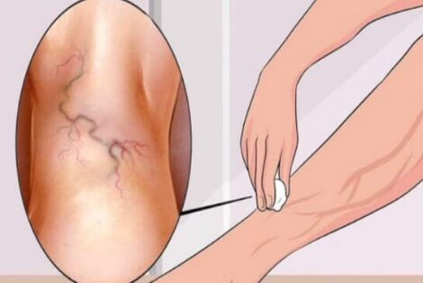 Varices