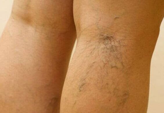 Varices