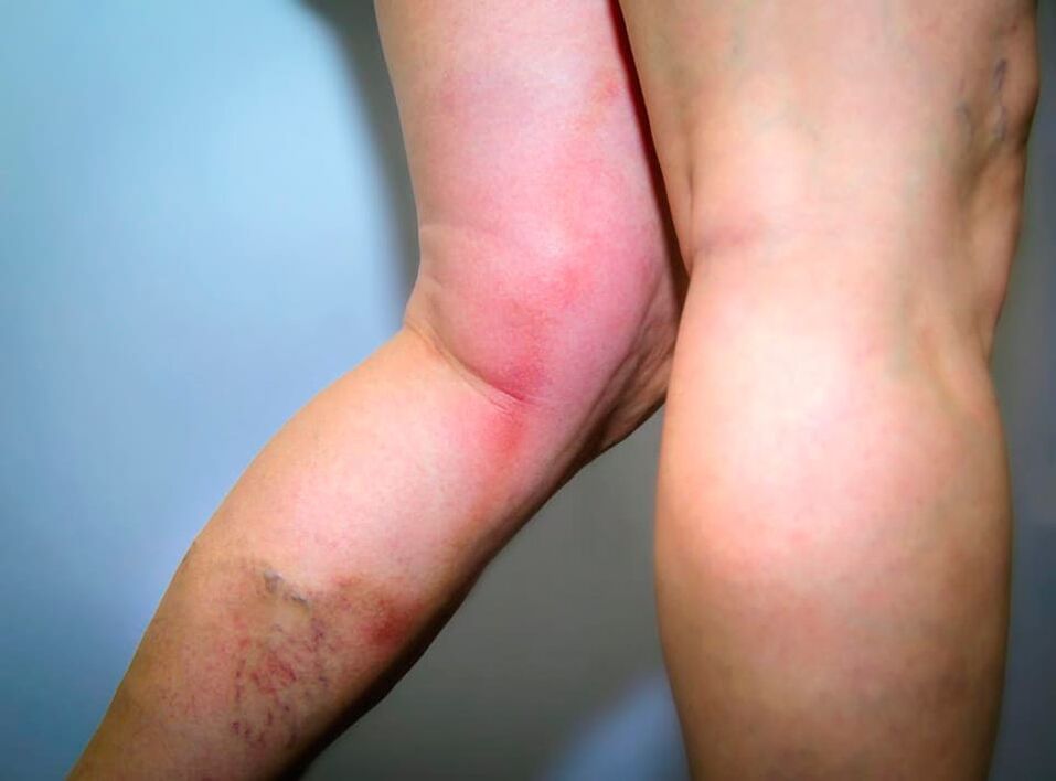 As consecuencias das varices
