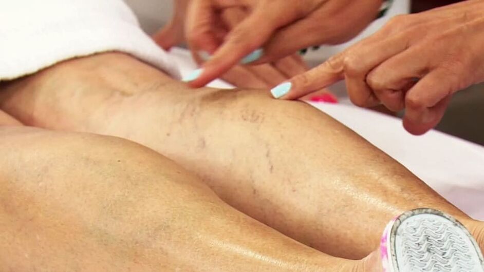 Varices na perna inferior