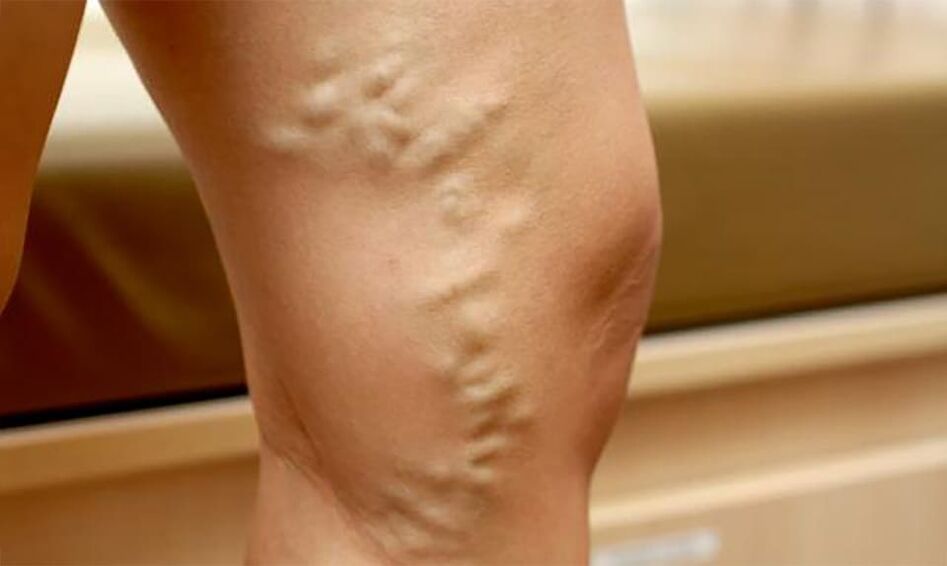 Varices na perna