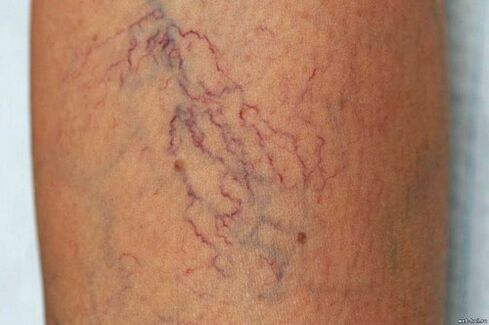 Por que son perigosas as varices