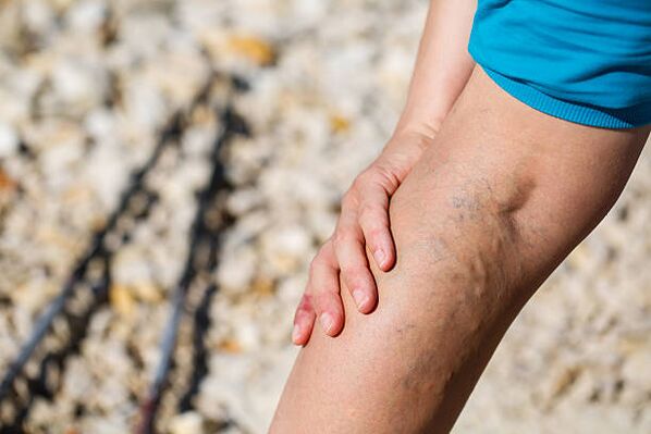 Varices das pernas