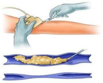 A escleroterapia é un método para tratar as varices