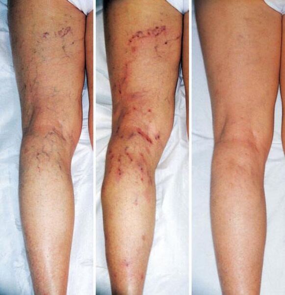 Etapas de varices das extremidades inferiores