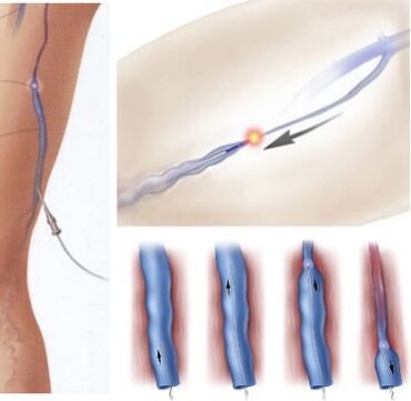 Método de tratamento de varices - coagulación láser endovenosa