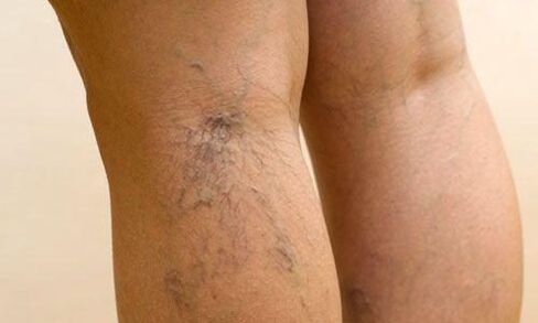 Varices nas pernas