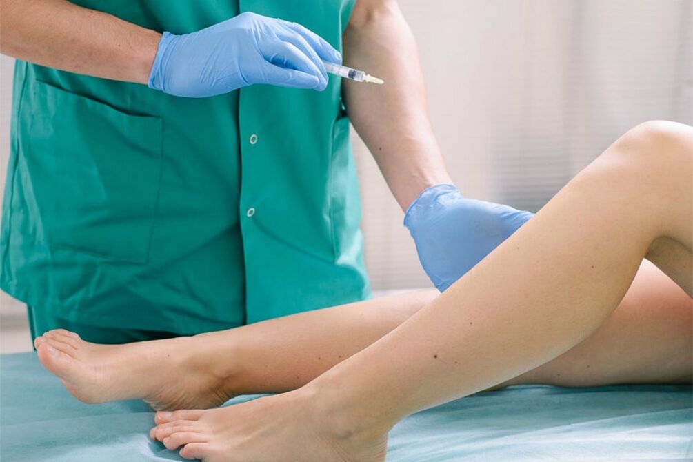 Escleroterapia para eliminar varices