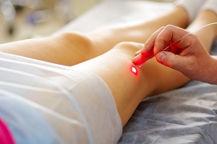 Tratamento con láser de varices