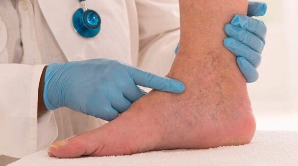 O doutor examina as pernas con varices