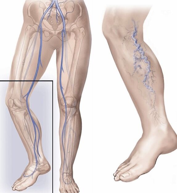 veas saudables e veas afectadas por varices